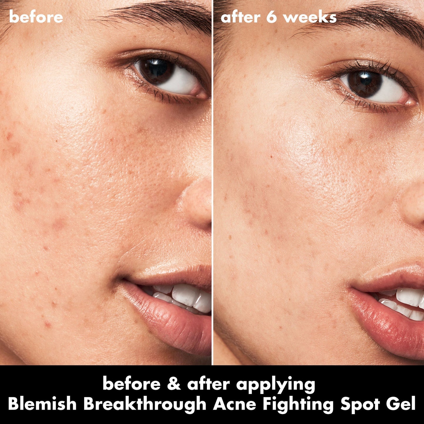 blemish-breakthrough-acne-fighting-spot-gel-j8 0326_EDU_BB_SpotGel_BA_ISABELLA.jpg