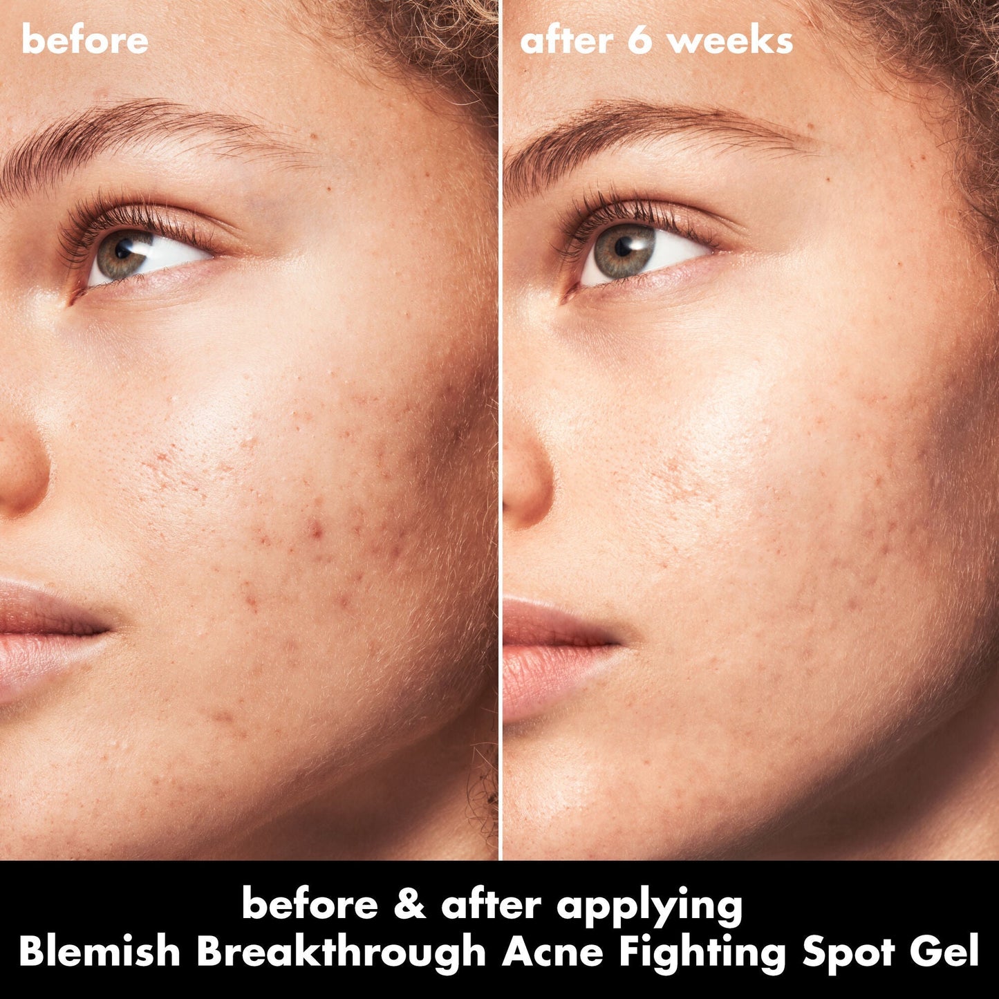 blemish-breakthrough-acne-fighting-spot-gel-j8 0326_EDU_BB_SpotGel_BA_MARLEY.jpg