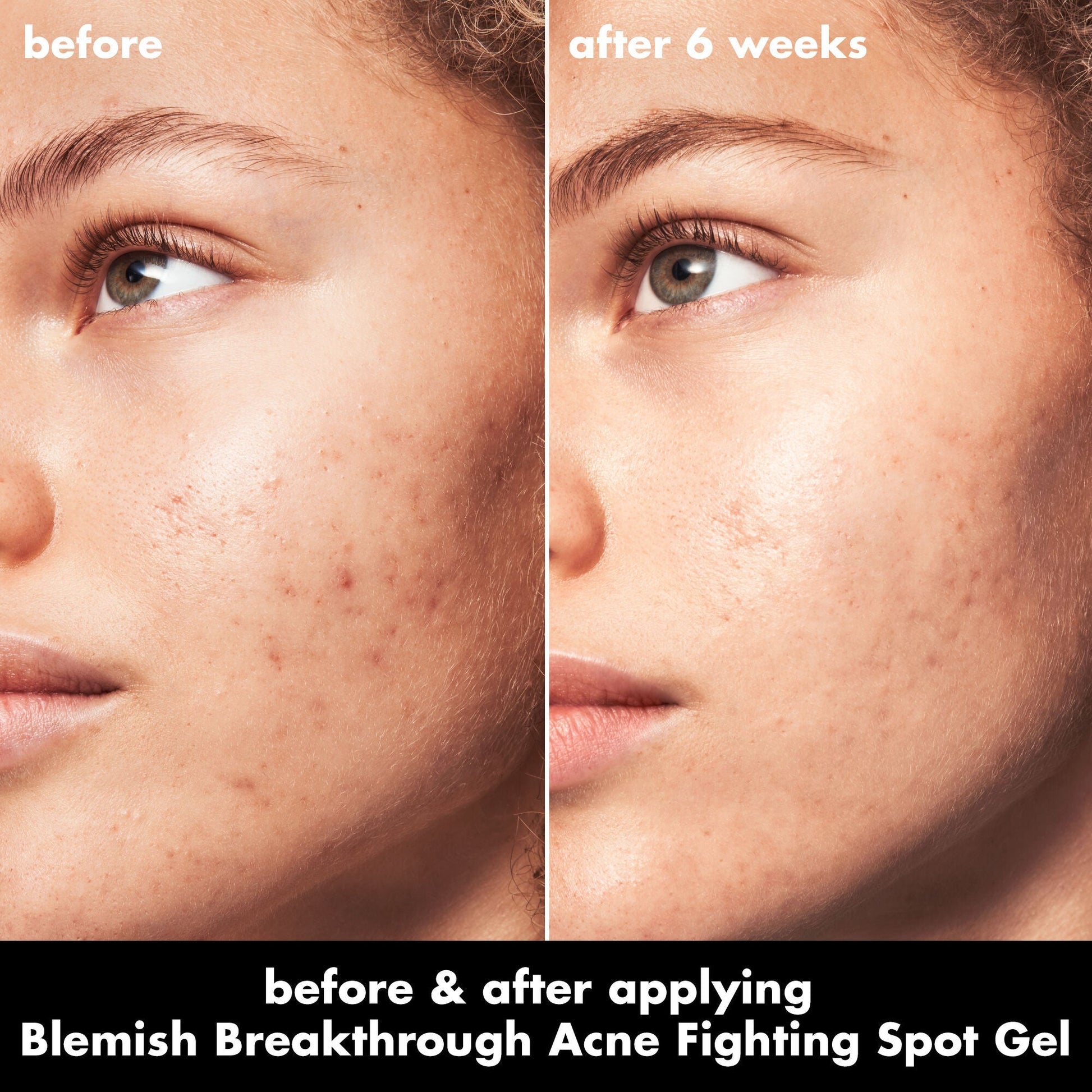 blemish-breakthrough-acne-fighting-spot-gel-j8 0326_EDU_BB_SpotGel_BA_MARLEY.jpg