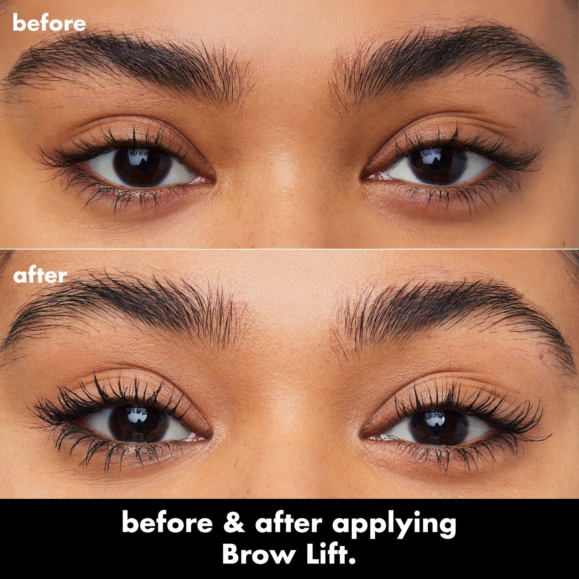 brow-lift-n8 0326_EDU_BrowLift_BA.jpg