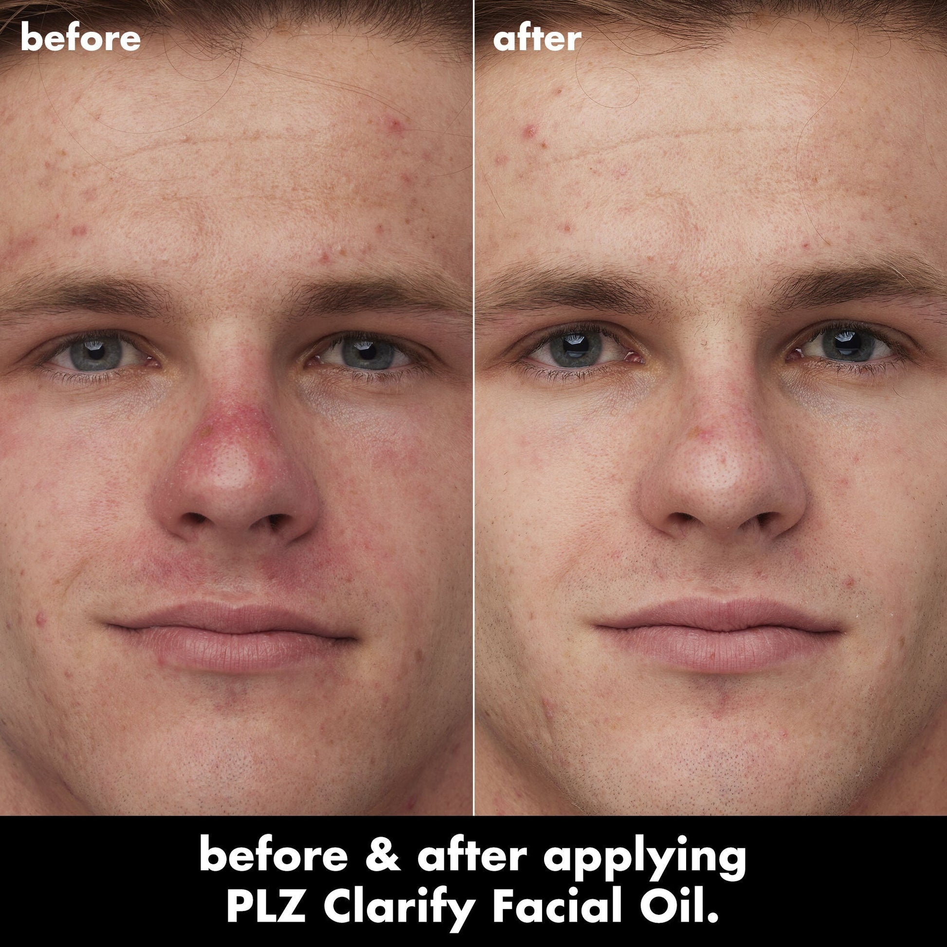 plz-clarify-facial-oil-c3 0326_EDU_PlzClarify_BA_Caleb.jpg