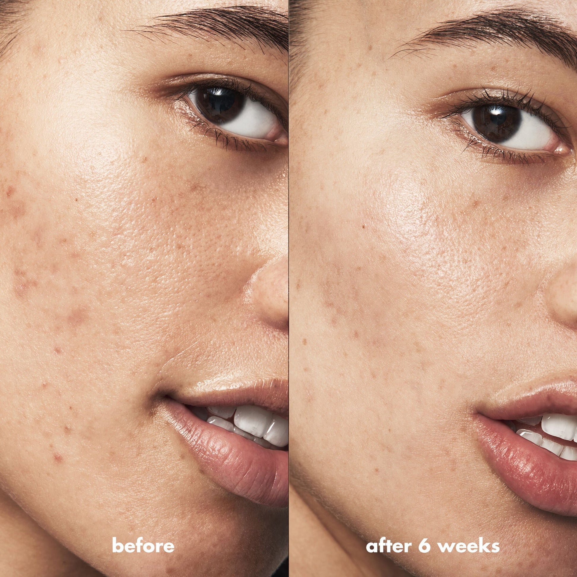 blemish-breakthrough-acne-clarifying-cleanser-k0 Acne_PDP_Isabella_Before_After_a3ff322b-cc6f-4b1a-9db3-bfb66c15d034.jpg