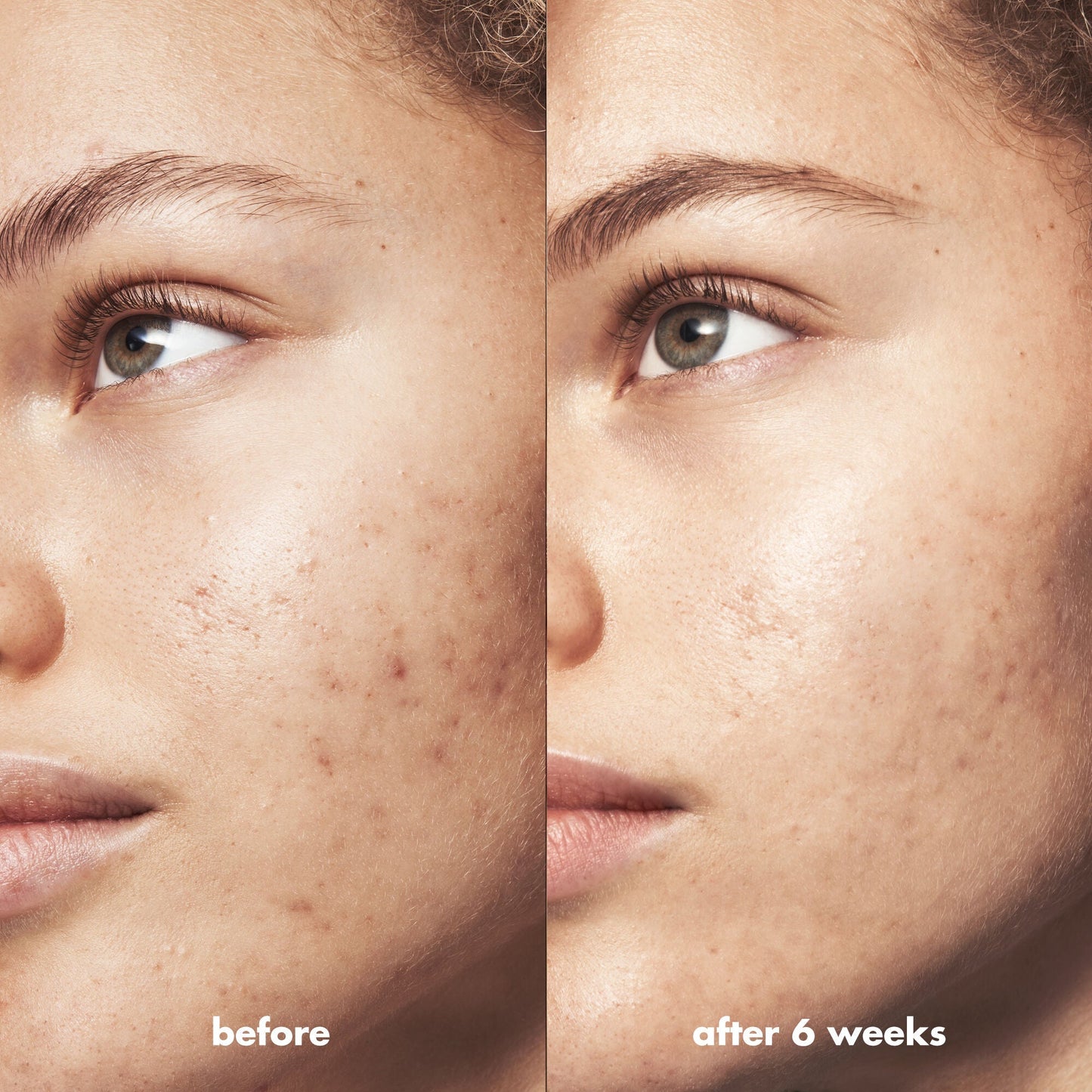 blemish-breakthrough-blemish-control-basics-kit-f5 Acne_PDP_Marley_Before_After_295728d2-6728-4f48-b8ef-c82bbca5b591.jpg